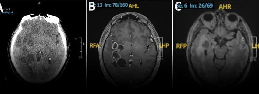  Beyond the Algorithm: Why Brain Worms Expose AI’s Global Diagnostic Blind Spots