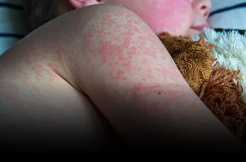  Measles Deaths Expose Silicon Valley’s Global Misinformation Blind Spot